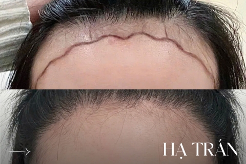 Hạ Trán